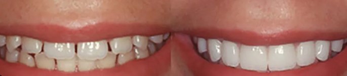 Unlocking Your Perfect Smile: A Comprehensive Guide to Dental Veneers