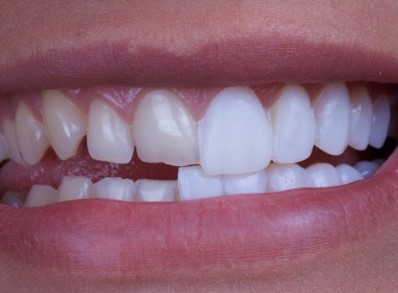 Unlocking Your Perfect Smile A Comprehensive Guide To Dental Veneers, Dental Veneer Guide, Perfecting Your Grin A Comprehensive Veneer Handbook, The Ultimate Veneers Tutorial, Achieving Your Ideal Smile A Complete Veneers Manual, Unlock Your Dazzling Smile Veneers Explained, Mastering Dental Veneers A Comprehensive Overview, Veneers Decoded Your Path to the Perfect Smile, Unleashing Your Confident Grin A Veneers Handbook, Dental Veneers Unraveled A Comprehensive Guide, The Definitive Veneers Encyclopedia, Unveiling Your Perfect Smile Veneers Demystified, Veneers Uncovered The Complete Guide to Dental Perfection, Smile Transformation 101 All About Veneers, Your Smile, Perfected A Veneers Companion, The AZ of Dental Veneers A Comprehensive Guide, Perfecting Your Smile The Veneers Encyclopedia, The Veneers Bible Unlocking Your Perfect Smile, Veneers Demystified A Complete Guide to Dental Perfection, Your Perfect Smile Unlocked A Veneers Handbook, The Comprehensive Veneers Compendium, Veneers 101 Your Path to the Perfect Smile, Mastering Your Veneers A Comprehensive Guide, Dental Veneers Made Easy Your Perfect Smile Unleashed